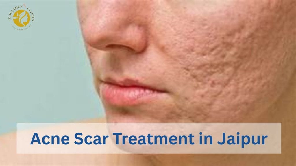 Acne Scar Treatment Cost in Jaipur