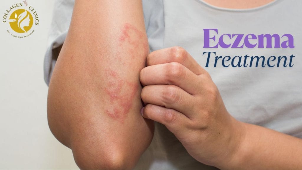 eczema treatment in jaipur