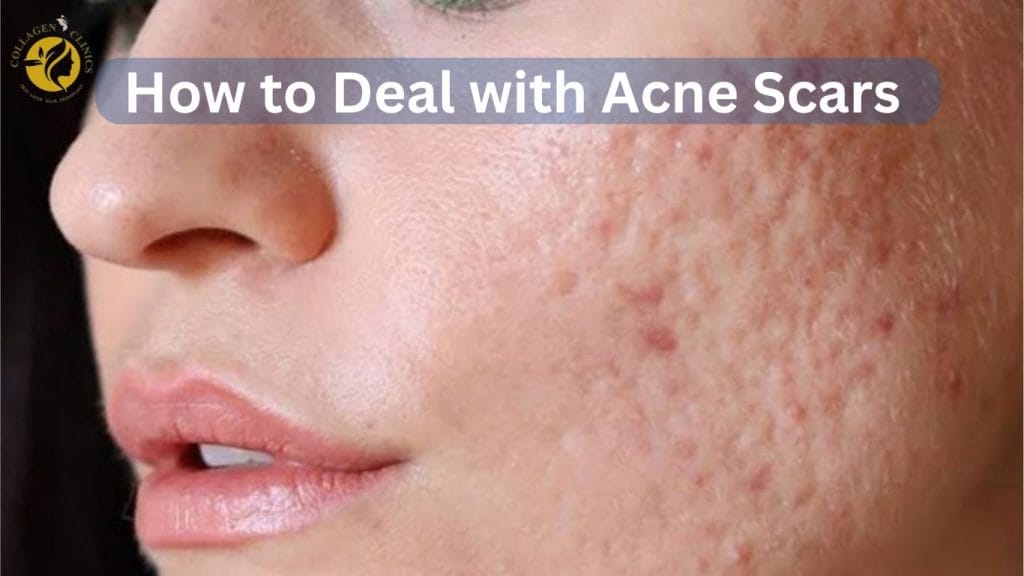 How to deal with acne scars collagen clinics jaipur
