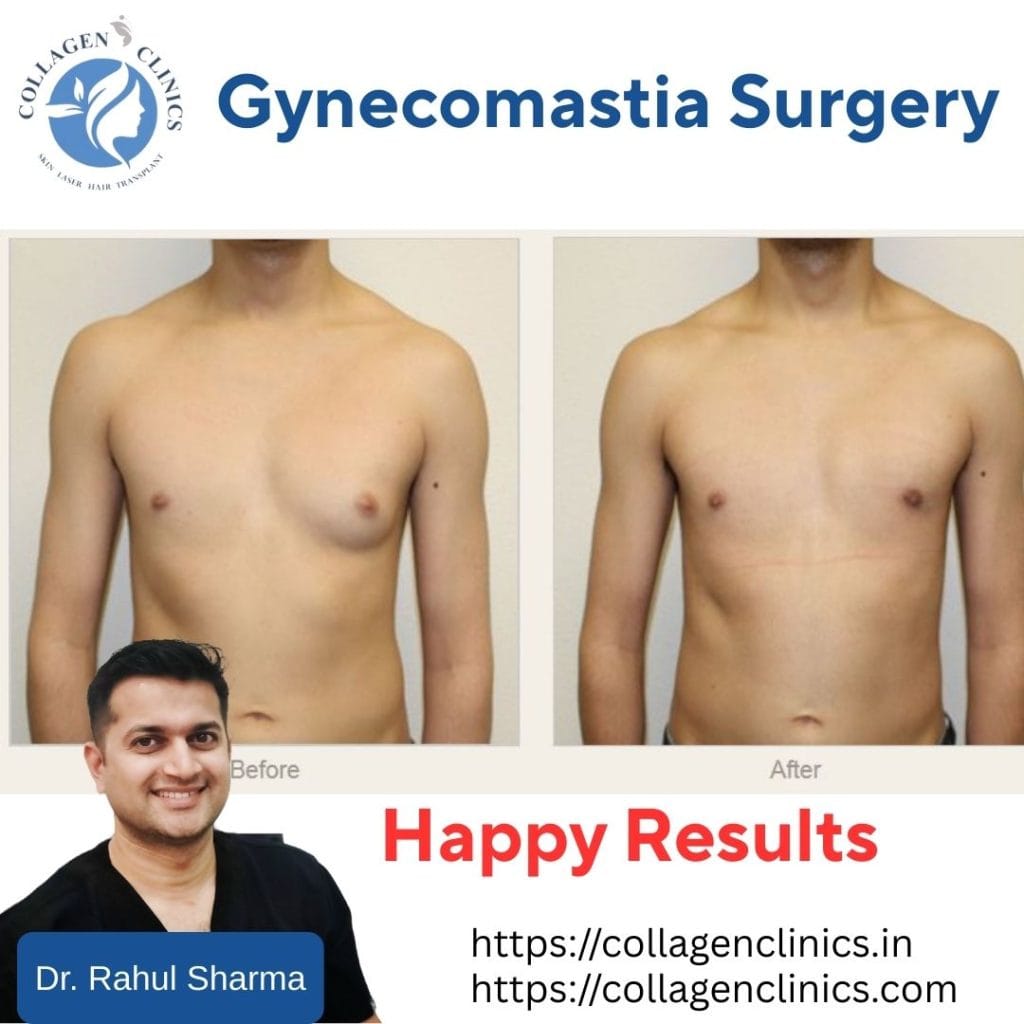 Gynecomastia Before & After Results- Collagen Clinics Jaipur