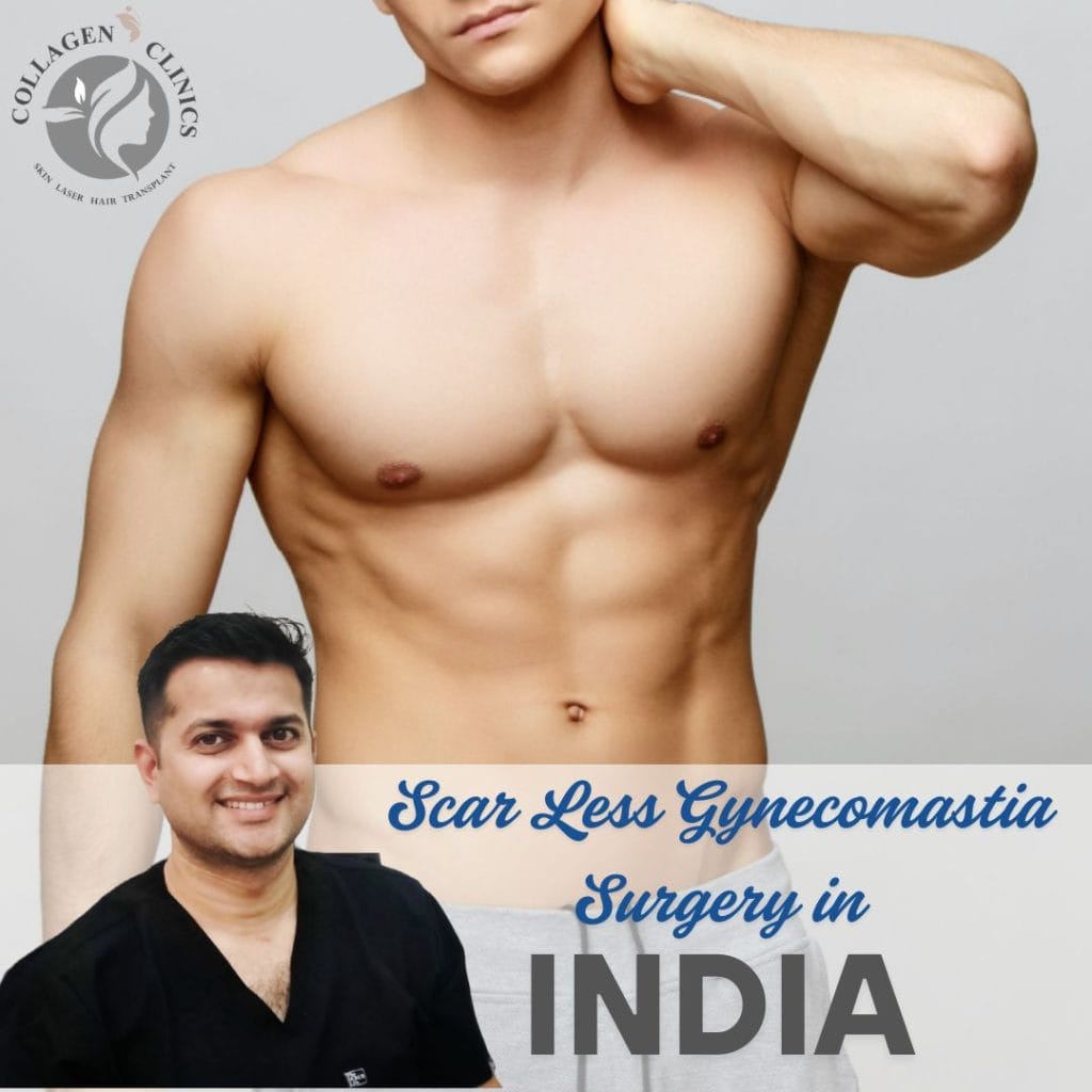 SCARLESS GYNECOMASTIA SURGERY IN JAIPUR