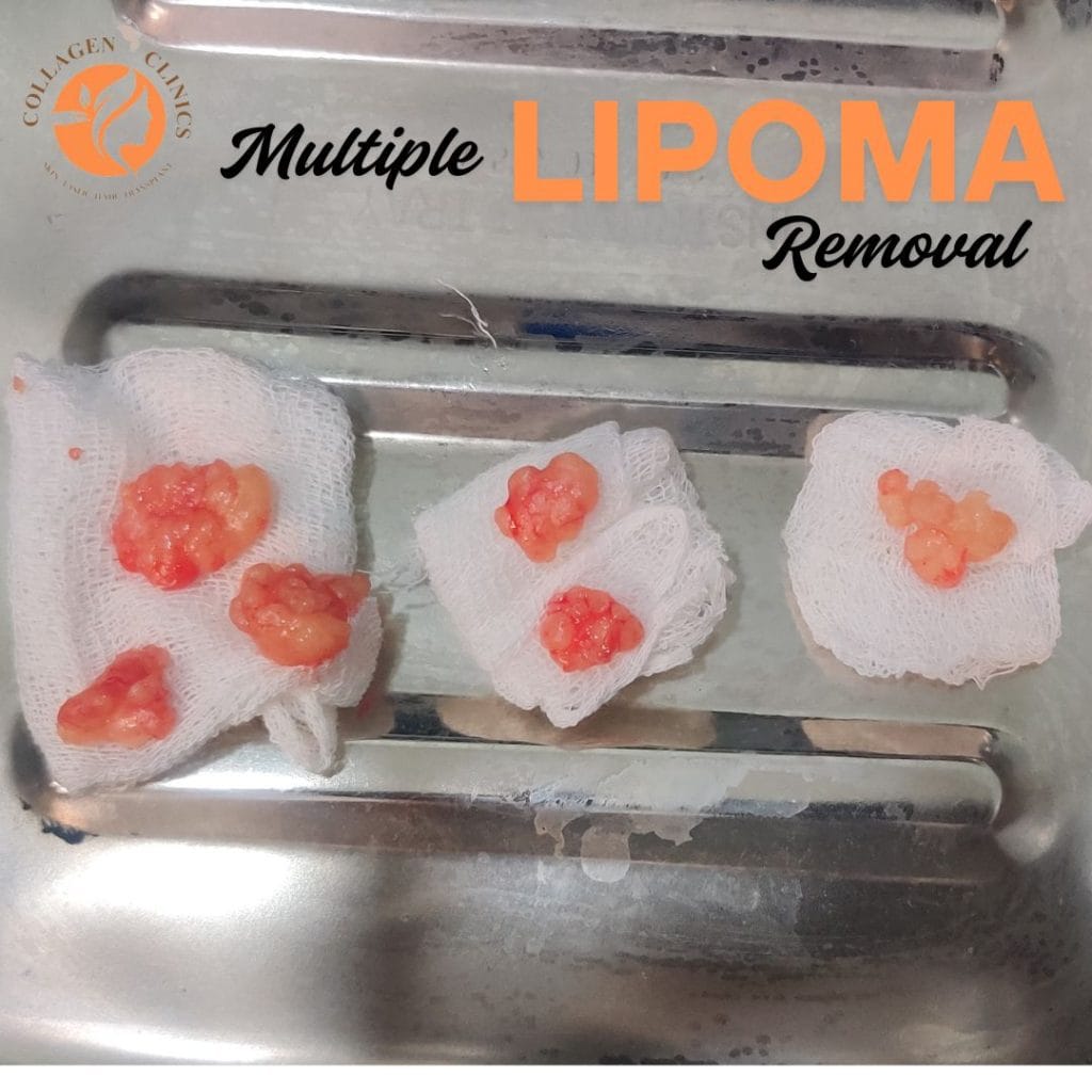 Multiple Lipoma Removal
